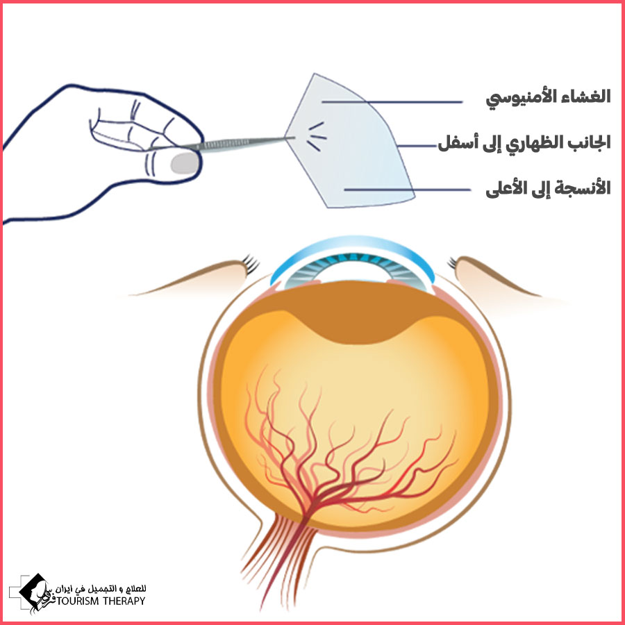 زرع الغشاء الأمنيوسي لعلاج طبقة القرنية