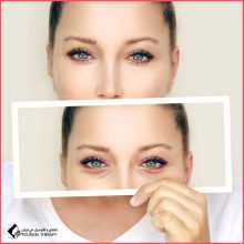 تجميل الجفون السفلية وعلاج انتفاخات تحت العين في مستشفى خدادوست شيراز
