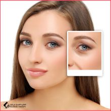 تجميل الجفون العلوية وعلاج ترهل الجفن في مستشفى خدادوست شيراز