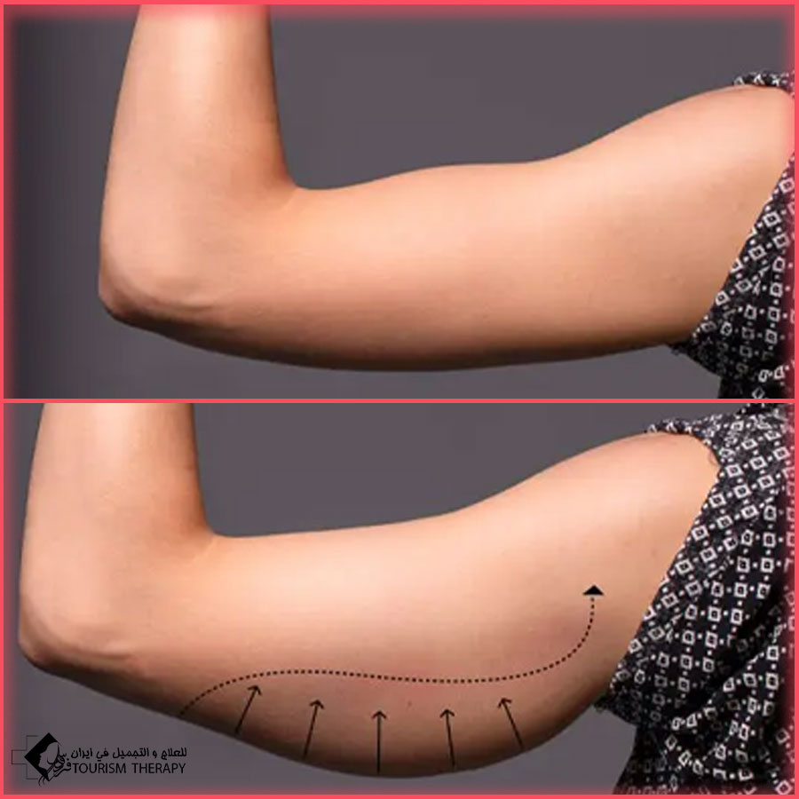 Brachioplasty Surgery in Tehran Dr.Fadaei Mohsen شفط وشد الذراعين