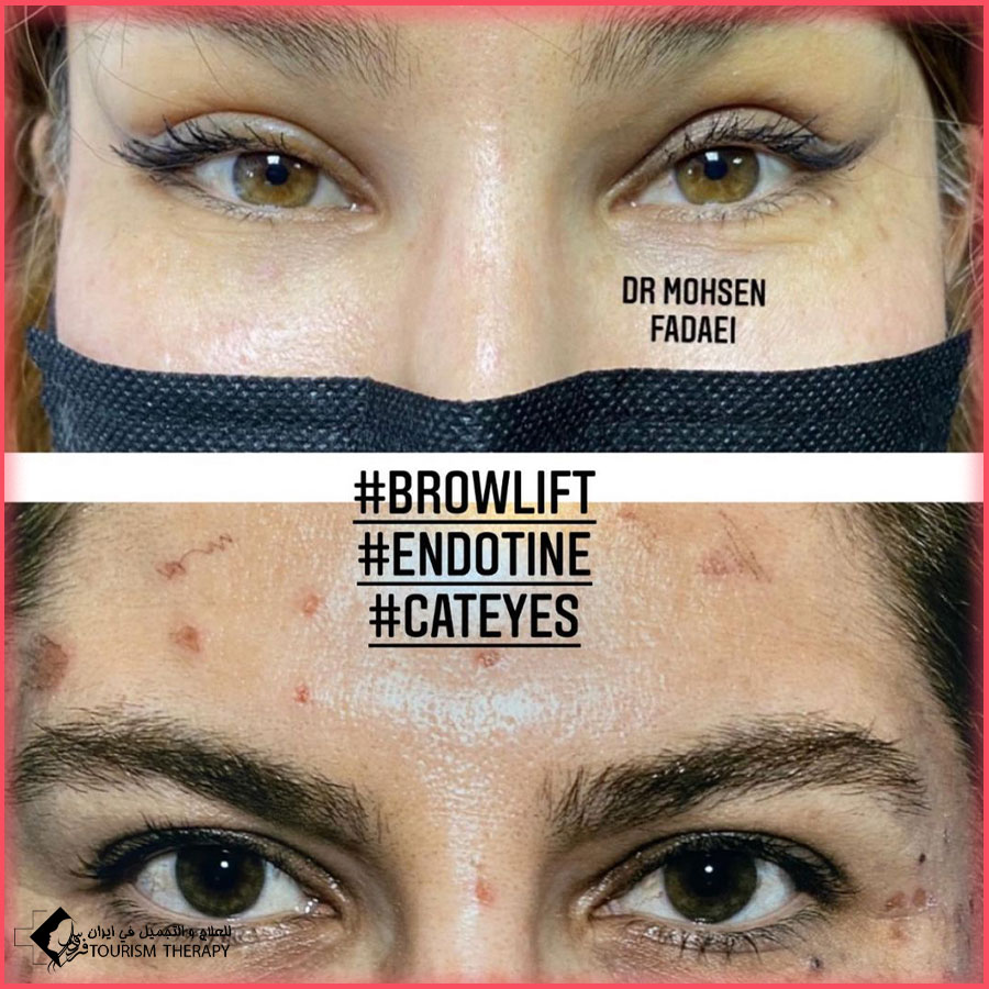 Cateyes dr fadaei عملية عيون القطة في طهران