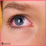خدش القرنية