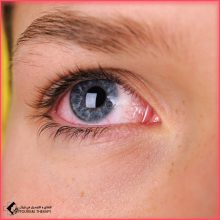 علاج خدش القرنية في مستشفى خدادوست شيراز
