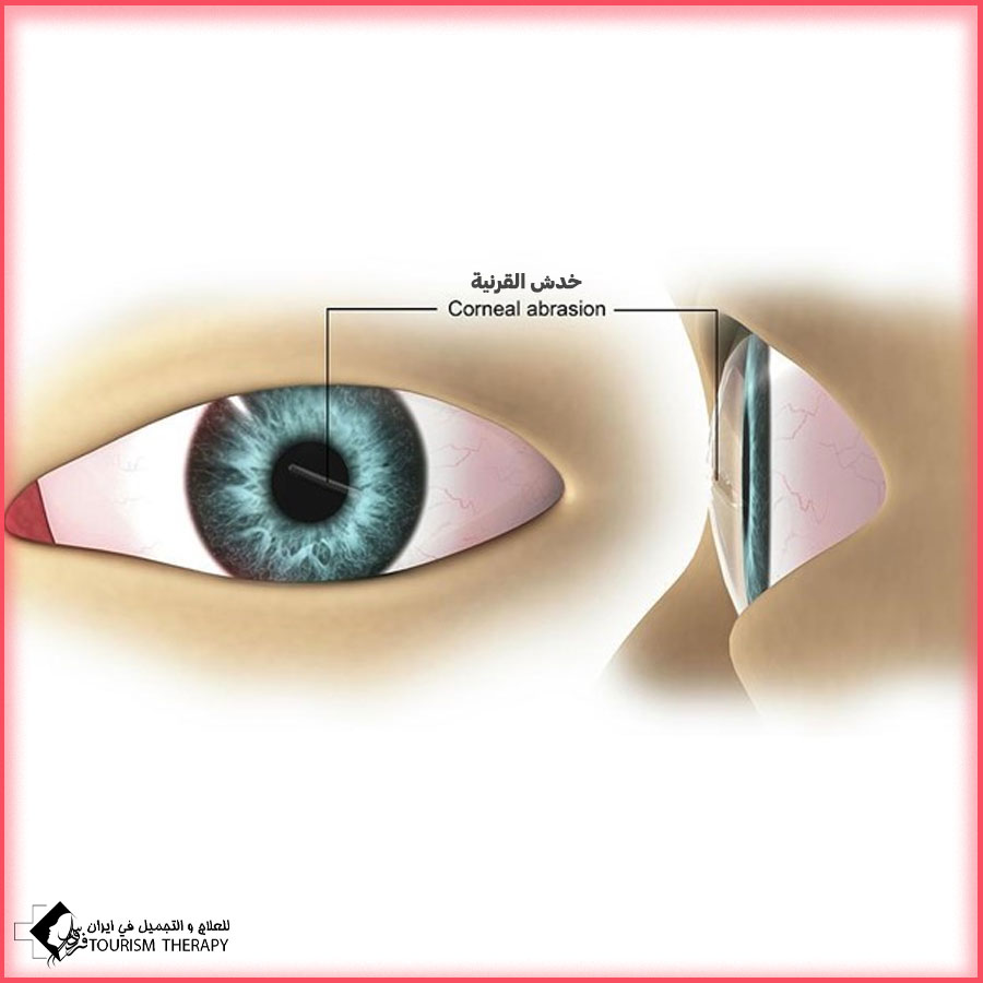 خدش القرنية