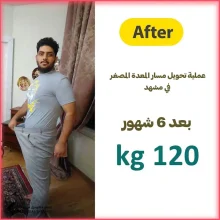 عملية تحويل مسار المعدة المصغر في مشهد مع الدكتور حامد گل محمد زادة