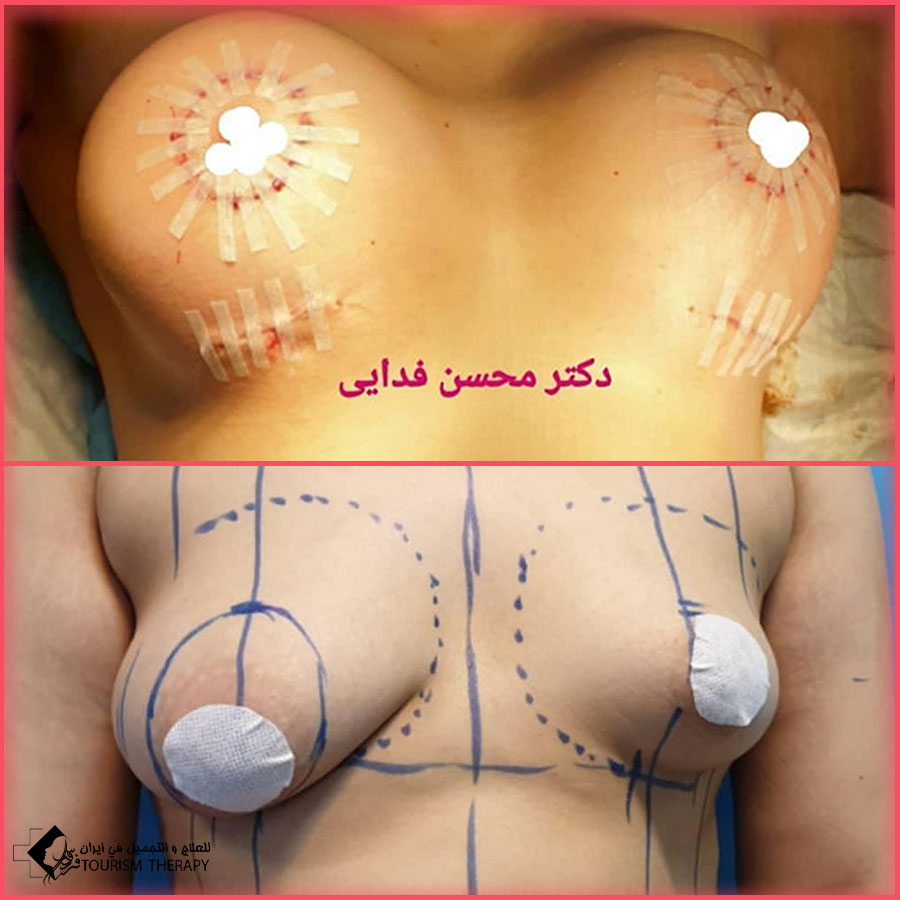 Crescent Breast Lift Technique dr fadaei تقنية شد الصدر الهلالي
