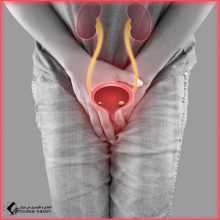 إزالة حصوات المثانة