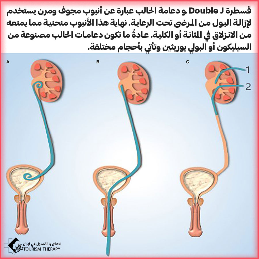 DOUBLE J in Mashhad عملية إزالة دعامة الحالب في مشهد