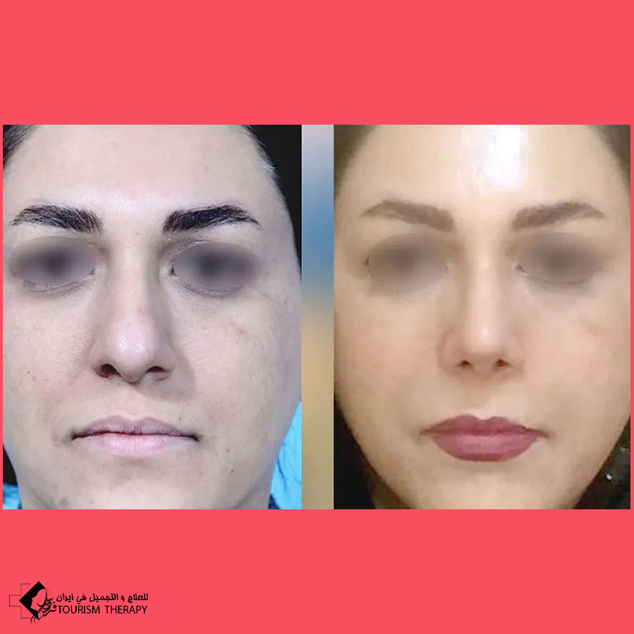 تجميل الأنف | الدكتور علي اصغر نريماني