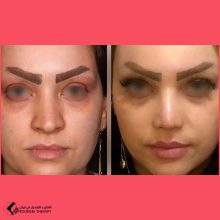 تجميل الأنف | الدكتور علي اصغر نريماني
