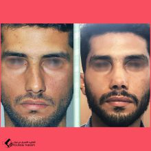 تجميل الأنف في اصفهان مع الدكتور علي رضا مؤمني افجدي