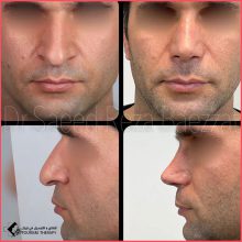 تجميل الأنف في اصفهان مع الدكتور سعيد رضا با عزت