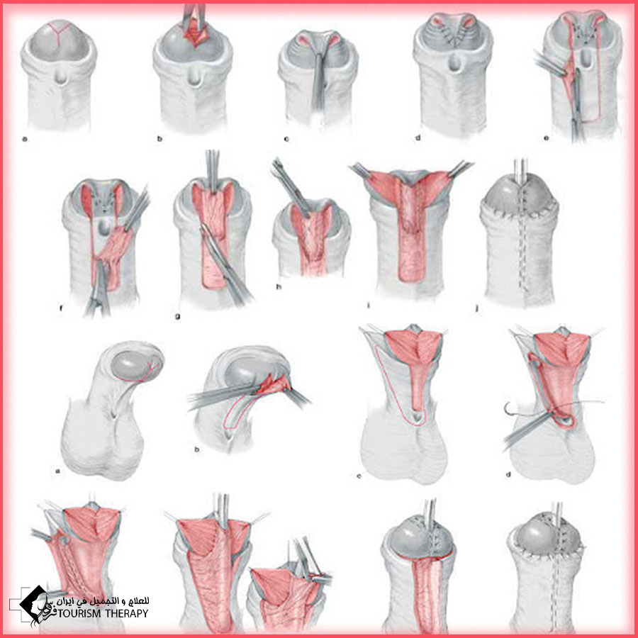 Distal Hypospadias Surgery Mashhad عملية المبال التحتاني في مشهد