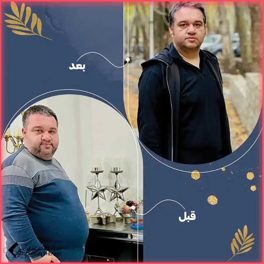 تكلفة عملية تحويل مسار المعدة في مدينة مشهد