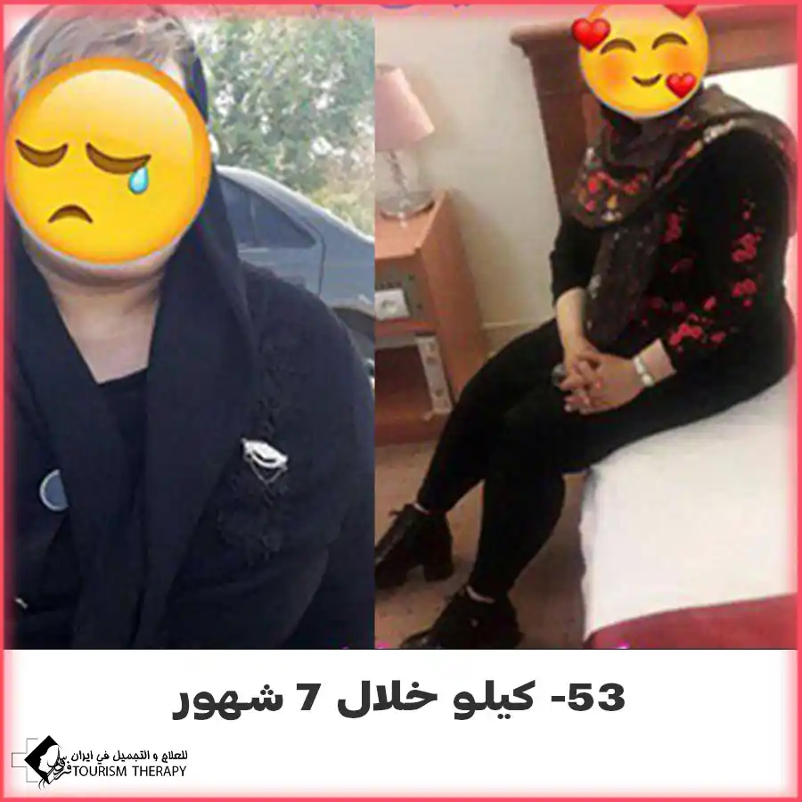 عملية تحويل مسار المعدة المصغر في مشهد مع الدكتور سجاد نور شفيعي