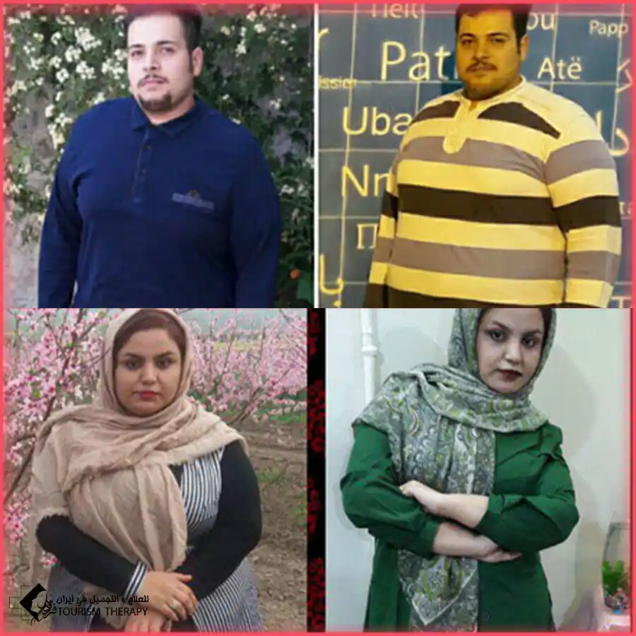قبل وبعد عملية تحويل مسار المعدة في مشهد مع الدكتور سجاد نور شفيعي
