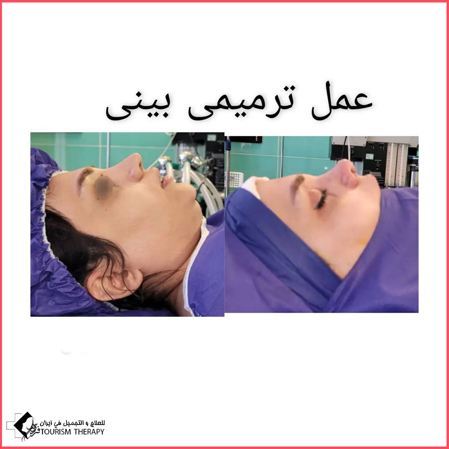 عملية تجميل الأنف | الدكتور عبد الحميد شريفيان