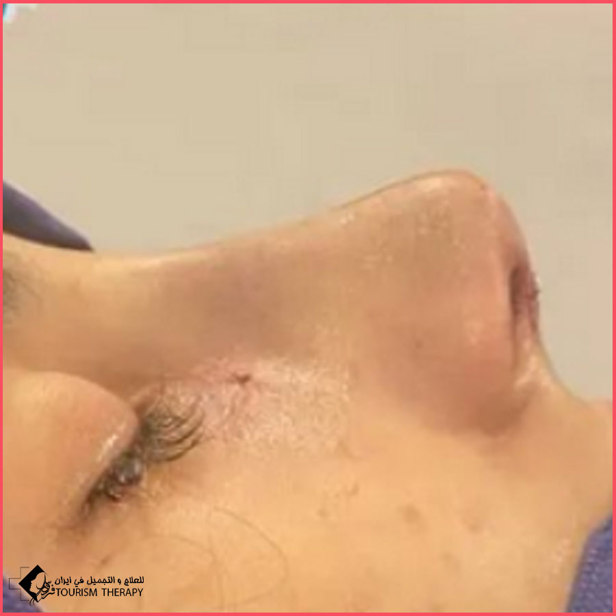عملية تجميل الأنف | الدكتور ابو الفضل عباس زادة