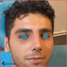 تجميل الأنف في طهران مع الدكتور ابو الفضل عباس زادة