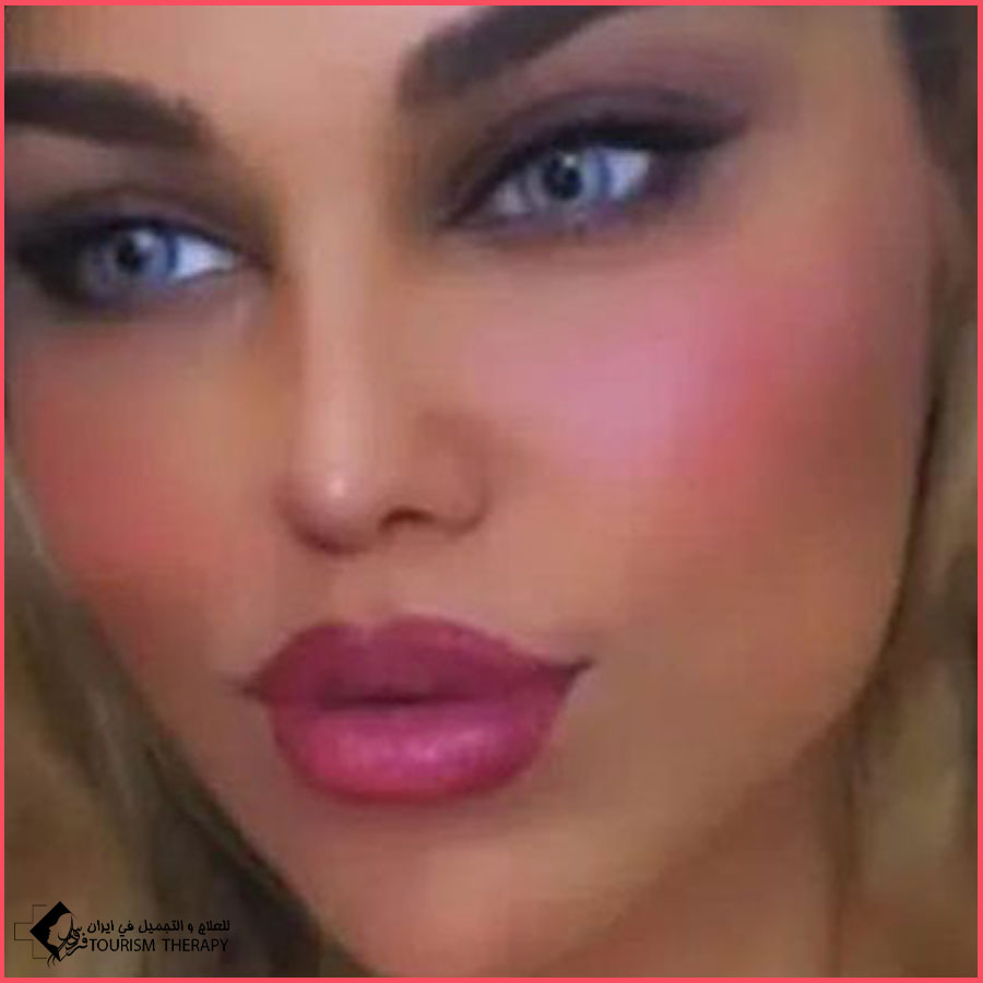 تجميل الأنف في طهران مع الدكتور علي ابراهيمي