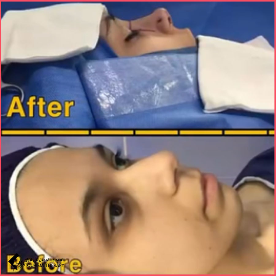 عملية تجميل الأنف | الدكتور علي ميقاني