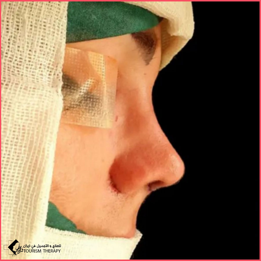 عملية تجميل الأنف | الدكتور علي شفيعي