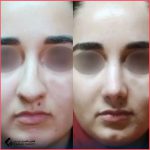 عملية تجميل الأنف | الدكتور مهدي امين خاكي
