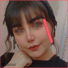 تجميل الأنف في اصفهان مع الدكتور امين قانعي