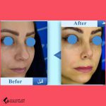 تجميل الأنف في مشهد مع الدكتور امير حسين سروري