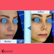 تجميل الأنف في مشهد مع الدكتور امير حسين سروري