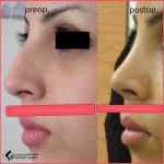 تجميل الأنف في مشهد مع الدكتور آرش بيرقي طوسي
