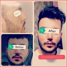 تجميل الأنف | الدكتور اسد الله عسكريان