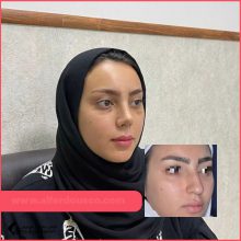 تجميل الأنف في مشهد مع الدكتور بشير رسوليان