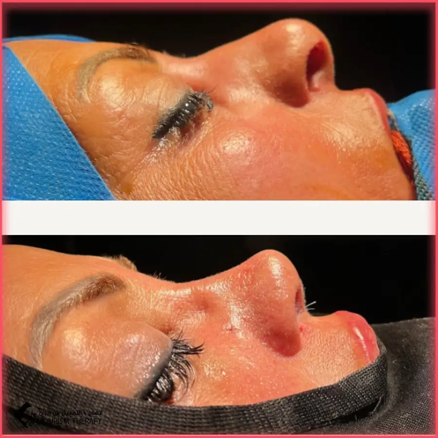 تجميل الأنف في مشهد بدقة عالية مع الدكتور احسان نصيرائي 3 تكلفة تجميل الأنف في مشهد بدقة عالية مع الدكتور احسان نصيرائی