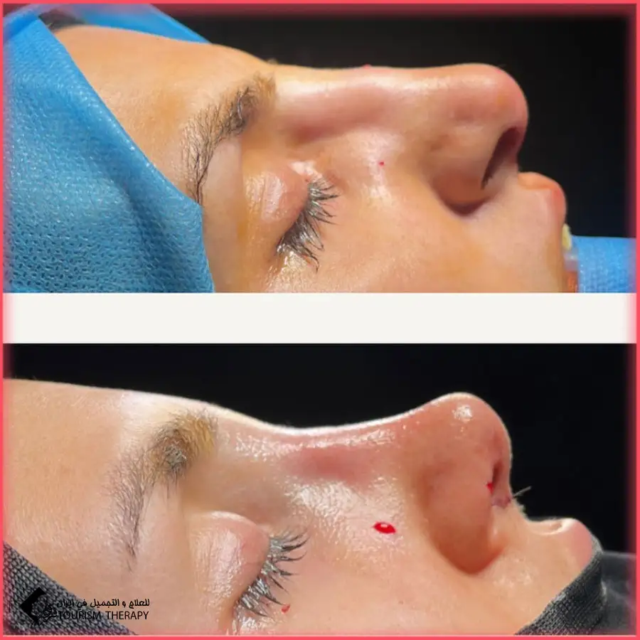 تجميل الأنف في مشهد بدقة عالية مع الدكتور احسان نصيرائي 2 عملية تجميل الأنف في مشهد بدقة عالية مع الدكتور احسان نصيرائي