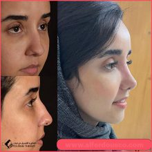 تجميل الأنف | الدكتور احسان مشتاقي