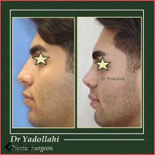 تجميل الأنف | الدكتور عنايت الله يداللهي