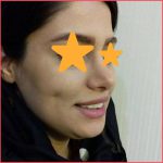 تجميل الأنف في مشهد مع الدكتورة فخر السادات جاووشي