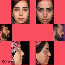 تجميل الأنف في اصفهان مع الدكتور حسين ابدالي