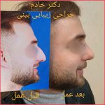 تجميل الأنف في مشهد مع الدكتور جلال خادم
