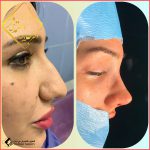 تجميل الأنف في مشهد مع الدكتور جلال معتمدي فر