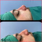 تجميل الأنف في مشهد مع الدكتور جواد اسلامي
