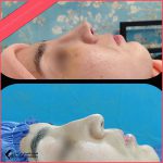 تجميل الأنف في مشهد مع الدكتور خسرو ابويساني