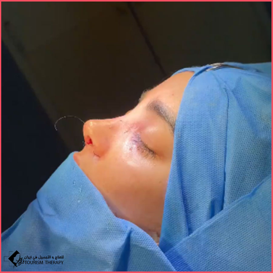عملية تجميل الأنف | الدكتورة ليلا ملكي