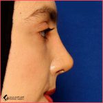 عملية تجميل الأنف | الدكتورة مهتاب رباني اناري