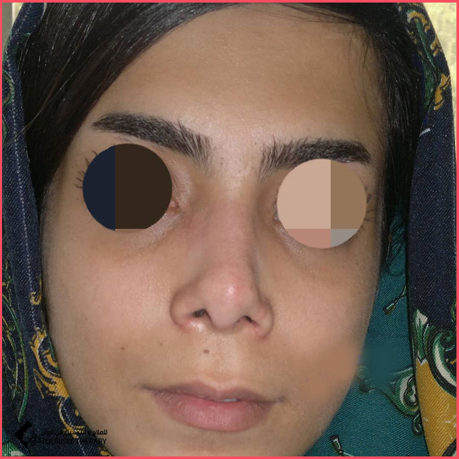 عملية تجميل الأنف | الدكتورة مريم خاكباز