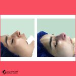 تجميل الأنف في مشهد مع الدكتور ميرزا محمد باقر علي زادة