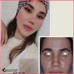تجميل الأنف في مشهد مع الدكتور اميد يازرلو