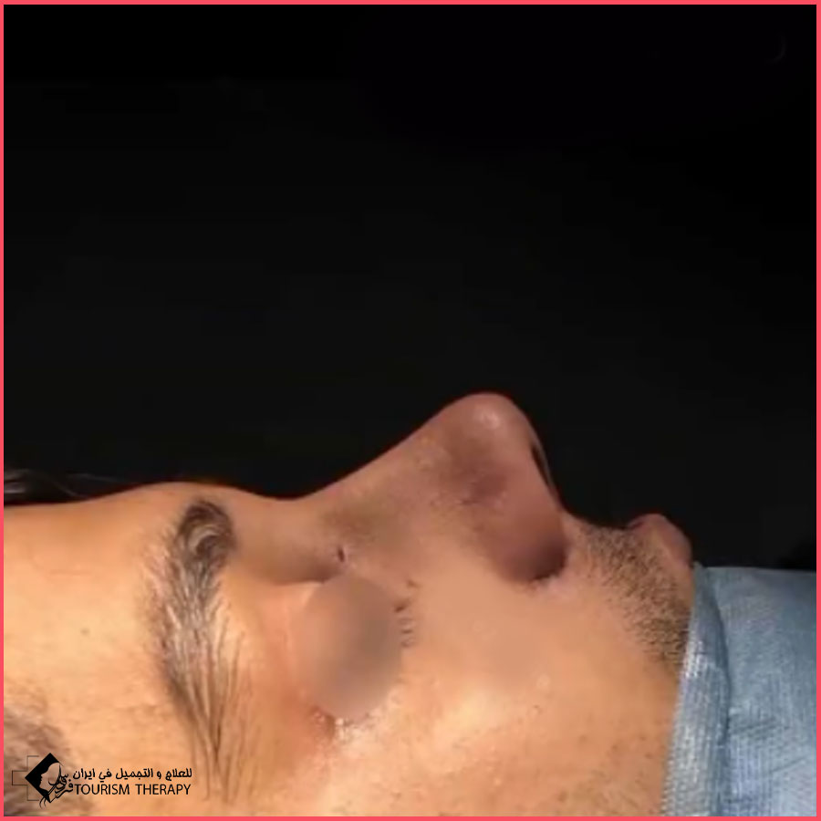 عملية تجميل الأنف | الدكتور رضا رفيع