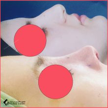 تجميل الأنف | الدكتور سعيد عبداللهي